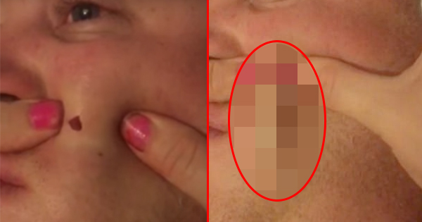 Wife Pops Husband’s Pimple That Has Been Growing For Four Years. She's Not Ready For What's About To Come Out.