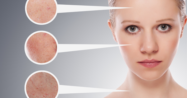 What Your Acne Is Telling You About Your Health