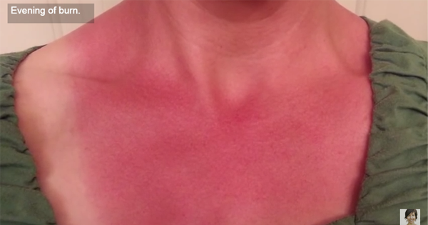 In Just 48 Hours, THESE 2 Natural Ingredients Will Heal Your Sunburn!