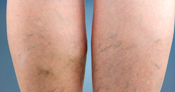 Banish Varicose Veins With These Natural Remedies