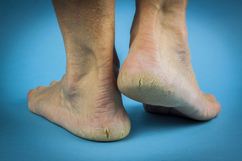 5 Incredible Home Remedies For Your Cracked Heels