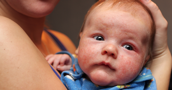 ALERT: If Your Baby Has Eczema, It Could Be The Beginnings Of...