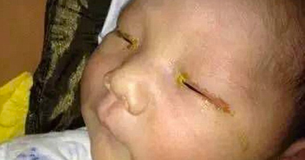 Infant Is Left Blind In One Eye After His Family Took His Photo With A Smartphone