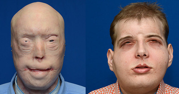 He Needed A Whole New Face...So These Doctors Made Sure He Got It.