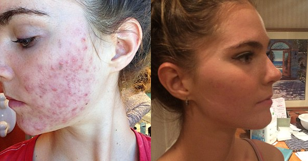 These Twins Try Everything To Get Rid Of Their Acne. Then, They Change ONE Thing About Their Diet...