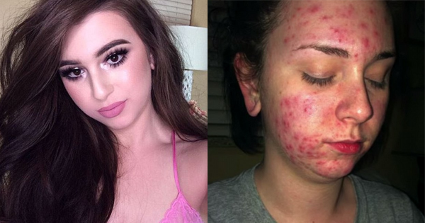 Her Acne Is So Bad That It