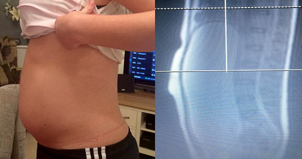 Doctor Suspects Teen Is Hiding Pregnancy When He Sees Her Belly—Until He Checks Her Scan