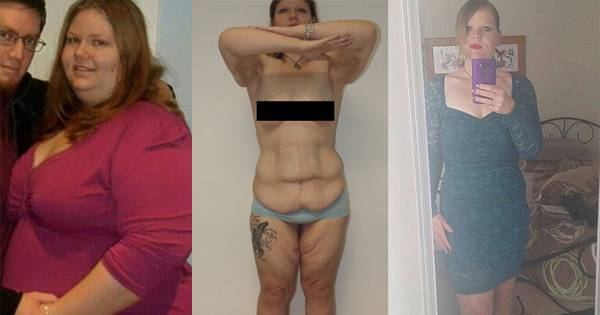 She Loses Over 200 Pounds In Just 18 Months, But Her Skin Isn