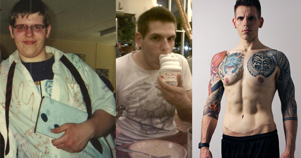 He Loses Weight And Has His Excess Skin Removed...But Then, He Has To Do It AGAIN