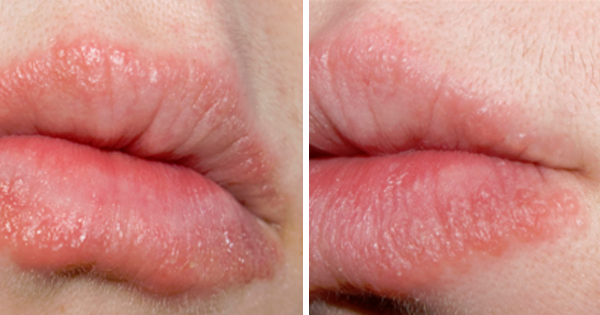 He Had EXTREMELY Chapped Lips. But This Foolproof Method Instantly Cured The Problem