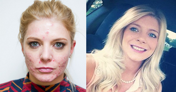 Woman Left With Painful Cystic Acne, Thanks To 
