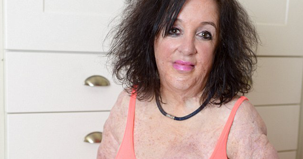 75% Of Her Body Is Covered In Burn Scars. Nothing Helped—Until She Went For A Swim