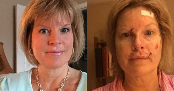 Woman Remembers Getting Bad Sunburns As A Child. Now She Wishes They