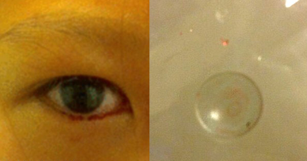 Girl Crying BLOODY Tears Visits An Eye Doctor. When They Flip Her Lid, IT Flies Out...