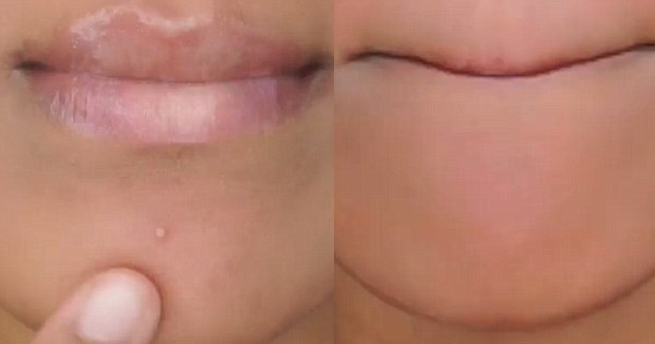 She Slices A Garlic Clove In Half And Presses It ON Her Chin. The Results Are Incredible!!