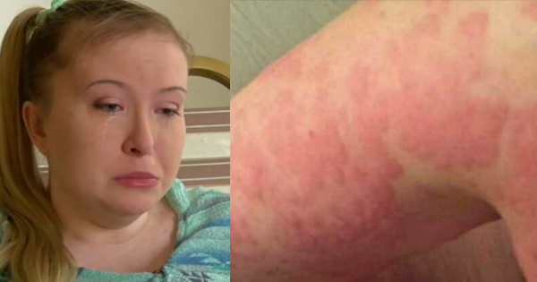 Woman Suddenly Breaks Out Into HIVES While Working Out. The Reason Why Is Heartbreaking