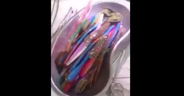 Surgeons Forced To Remove 20 TOOTHBRUSHES From A Patient
