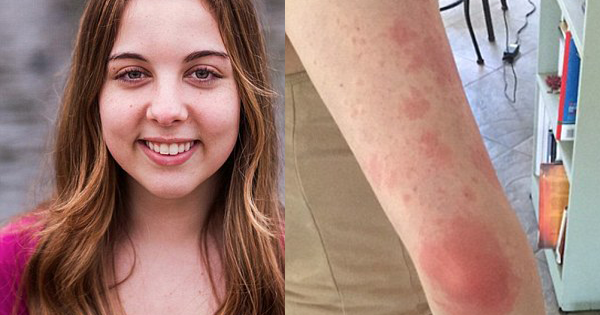 Woman Who Goes Into Anaphylactic Shock From WEATHER Changes Finally Finds Help