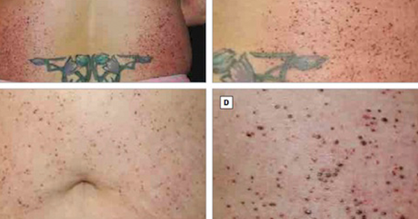 She Wakes Up To Find THOUSANDS Of Moles All Over Her Body. The Reason Why? WHOA...