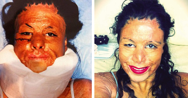 What This Woman Put IN HER HAIR Left Her Entire Body Covered In Burns