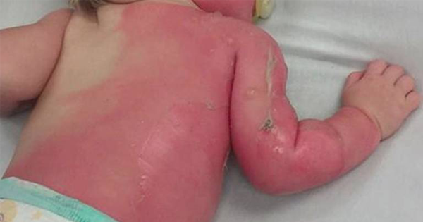 Her Toddler Got Severely Burned By THIS Common Household Tool