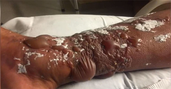 He Wakes Up To See His Leg Looking Like THIS. It Only Gets Worse…