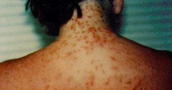 Sea Lice Are Invading Our Beaches — Learn How You Can Avoid Being Stung This Summer