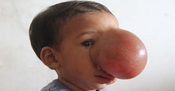 She Was Born With A Rare Tumor On Her FACE. Her Parents Aren’t Sure If Her Life Can Be Saved…