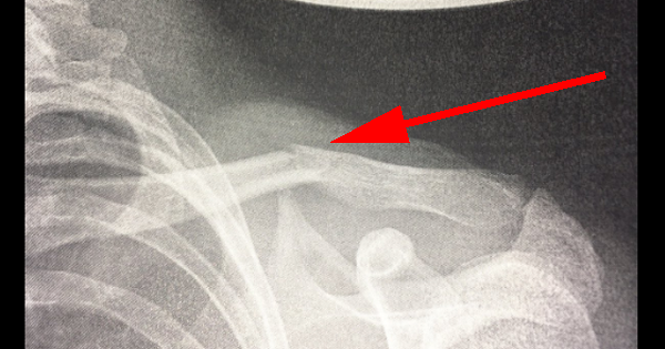 OMG! He Broke His COLLARBONE. How? Just Look At His Cell Phone...