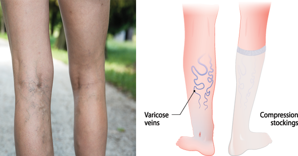 I Had No Clue That Varicose Veins Are A Sign Of THIS. It