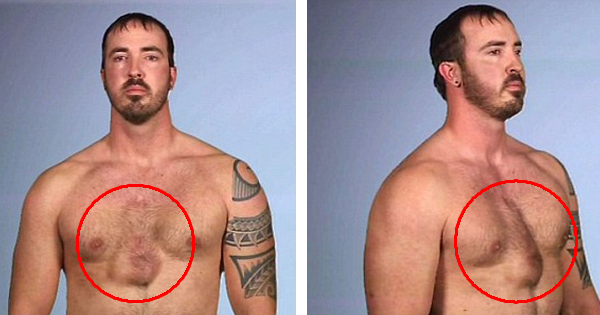 He Nearly Kills Himself By Using A Syringe To Drain A Fluid Buildup In His Chest
