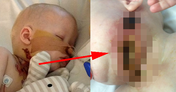 His Simple Bout Of Chicken Pox Transforms Into A Flesh-Eating Disease That Nearly Takes His Life