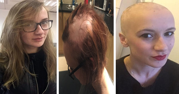 She Loses ALL Of Her HAIR. When Her Doctors Tell Her Why, She