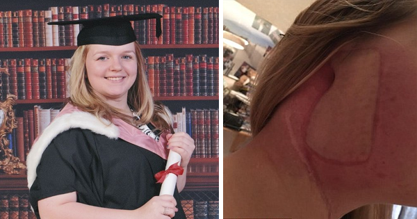 She Made A Horrifying Discovery While Getting Her Ear Pierced. Now, Doctors Have Removed Her Ear