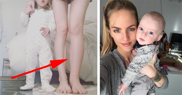 One Of Her Legs Swells Unnaturally After Pregnancy, But There