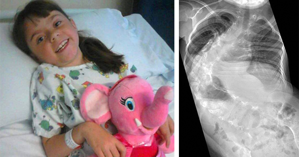 She Has A 170-Degree Curve In Her Spine That Requires Titanium To Fix