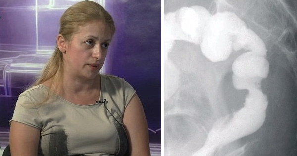 Her Doctors Completely Mess Up When They Connect Her Colon To Another Part Of Her Body
