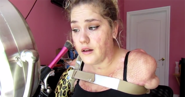 She Loses All Four Limbs In A Span Of 24 Hours When Disease Ravages Her Body Now She S Filming