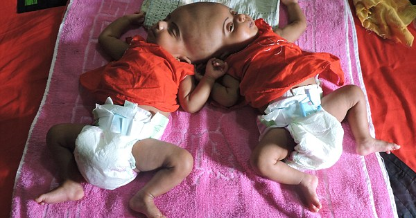 These Identical Twins Are Born Conjoined At The Head, But Doctors Aren