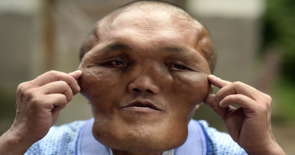 His Facial Deformities Cause Him To Go Deaf, But There