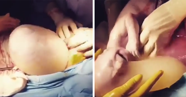Watch Doctors Deliver A Baby Still In Its Amniotic Sac