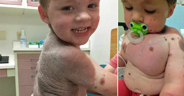 Toddler Undergoes 26 Breast Implant Surgeries To Avoid Developing Cancer