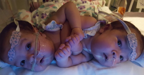 Conjoined Twins Who Share The Same Heart Weren
