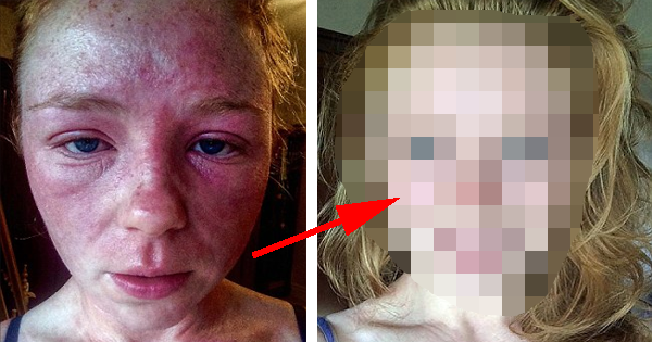 Her Skin Condition Used To Leave Her Bed Soaked With Blood, But After Changing Her Diet, Her Skin Looks Incredible