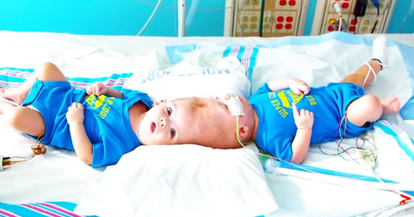 13 Months After Their Conjoined Twins Are Born, These Parents Finally Prepare To Separate Them – And Potentially Say Goodbye