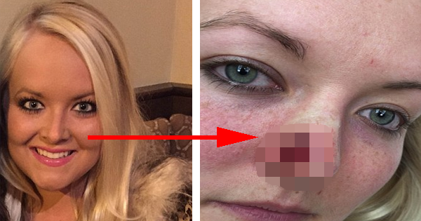 Sunbeds Leave This Woman With A Hole In Her Nose The Size Of A Coin