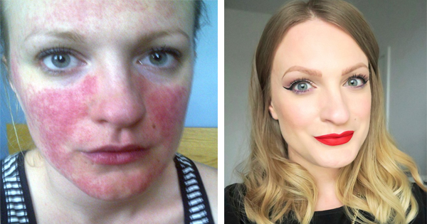 She Treats Her Incurable Skin Condition By Completely Revamping Her Diet