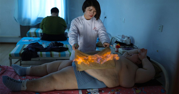 An Obese Boy Is Being Set On Fire As Part Of His Weight Loss Treatment