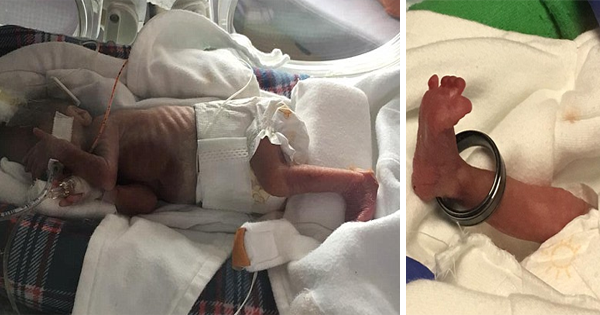 This Premature Baby Is Born So Early, His Father