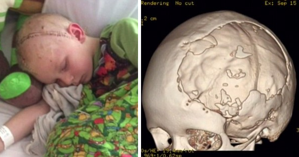 After Cracking His Skull, He Has To Wear A Helmet For Two Years. Now, A 3-D Implant Is Giving Him A New Life.